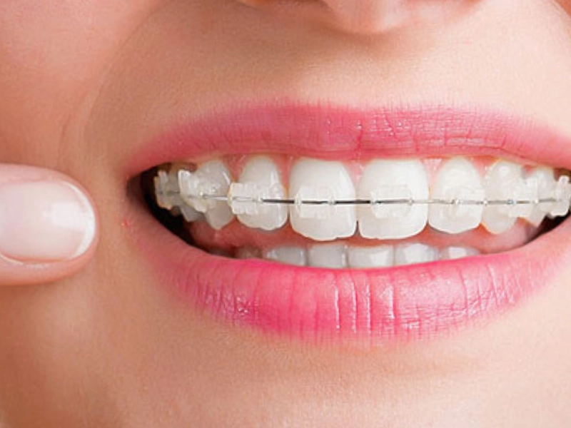 Aparelho ortodôntico estético de safira