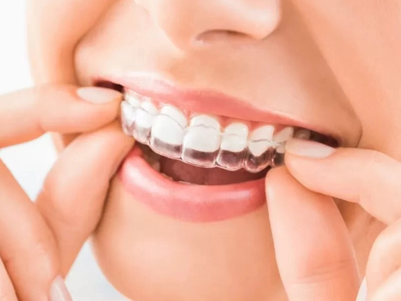 Aparelho invisível Invisalign em Piracicaba